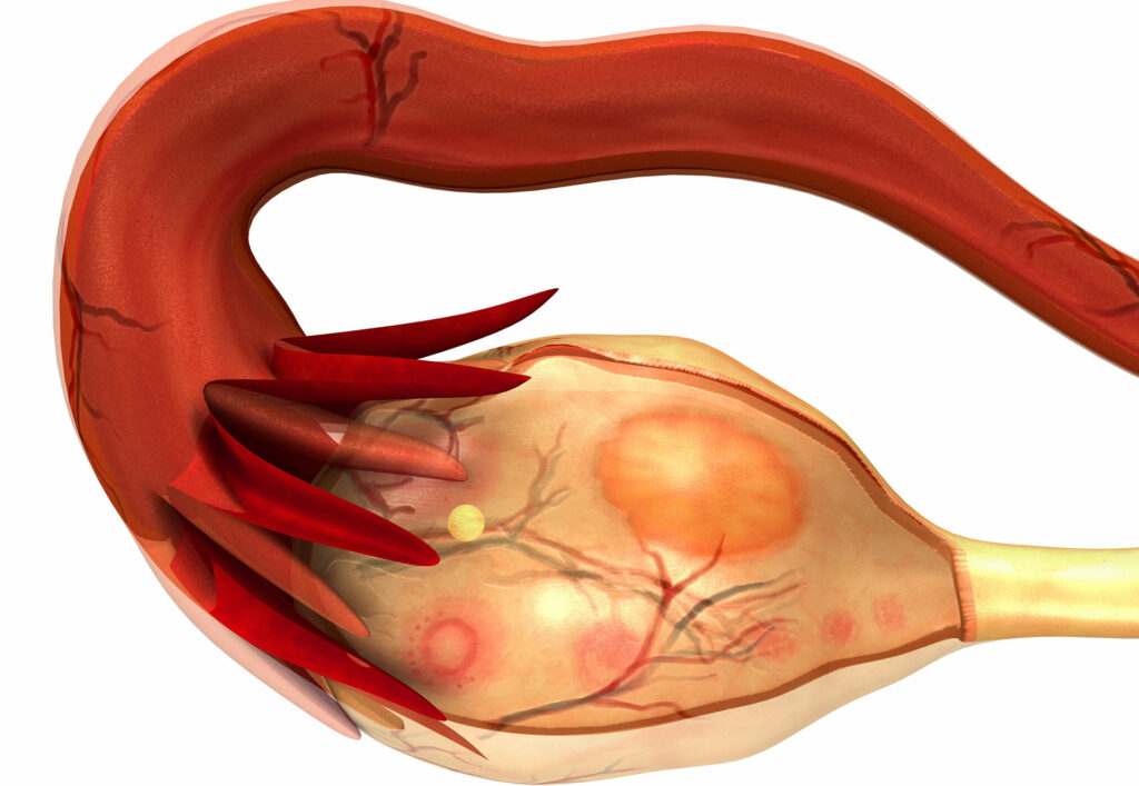 L’acupuncture et le Syndrome des Ovaires Polykystiques (I)