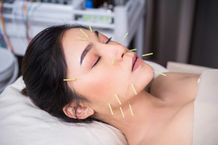 acupuncture et nevralgie faciale par le dr Nguyen à Paris