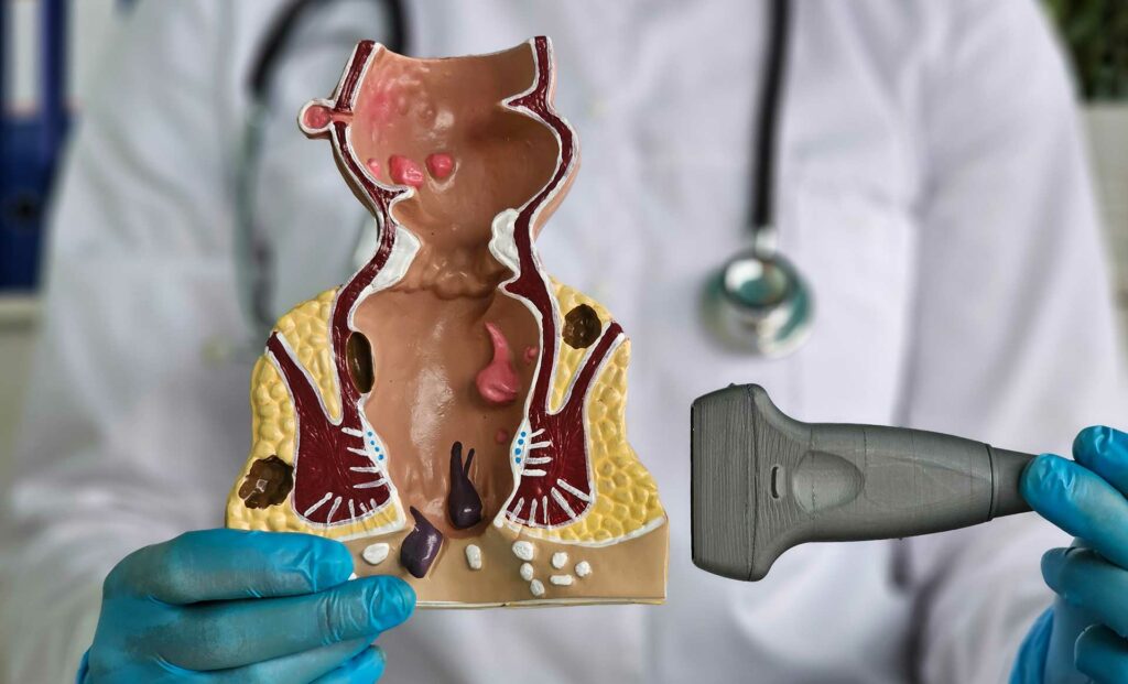 L'Acupuncture et les Hémorroïdes