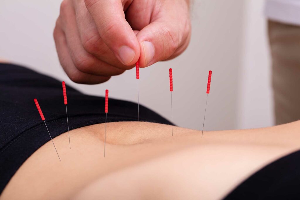 Acupuncture contr eles hémorroides