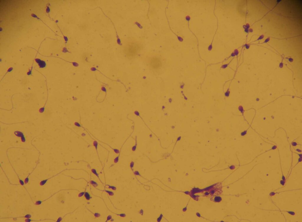 Azoospermie et acupuncture à Paris