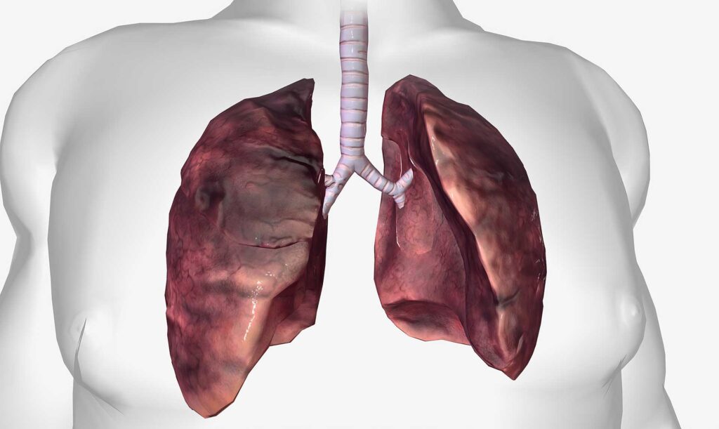 L’Acupuncture Face à la Fibrose Pulmonaire