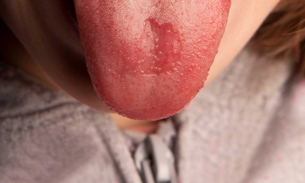 Syndrome de la bouche brûlante : apaiser l’inconfort par l’acupuncture