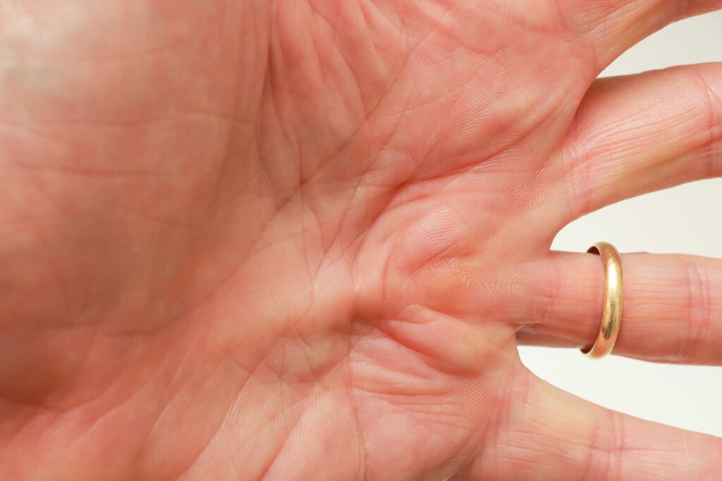 Maladie de Dupuytren : quand l’acupuncture redonne de la souplesse à la main