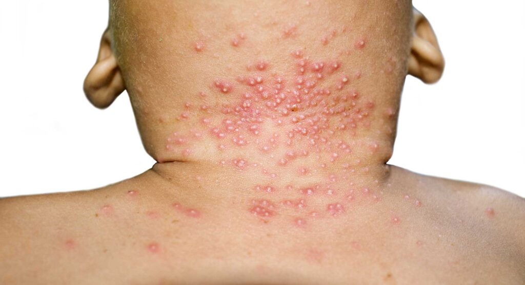 Acupuncture et immunomodulation cutanée