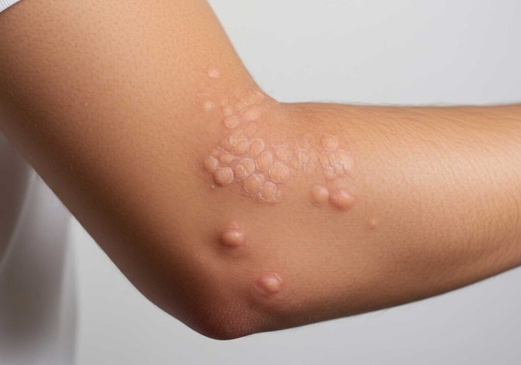 L’acupuncture dans le molluscum contagiosum