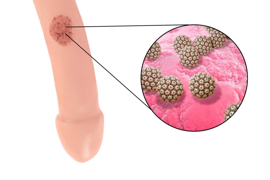 Condylomes acuminés : l’acupuncture pour renforcer les défenses immunitaires