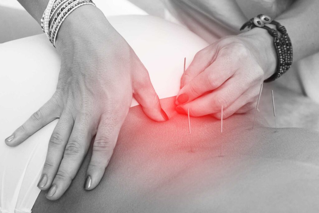 Tecnhiques d'acupuncture par le dr Nguyen à Paris