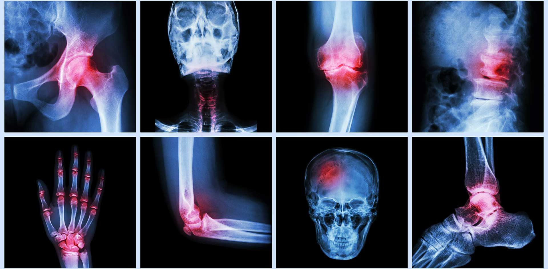 Acupuncture et Algodystrophie