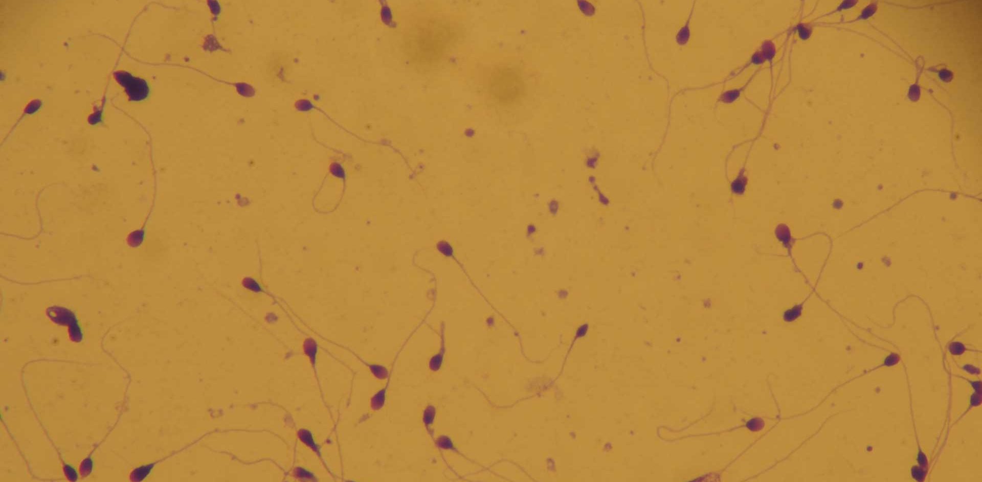 Azoospermie et acupuncture à Paris