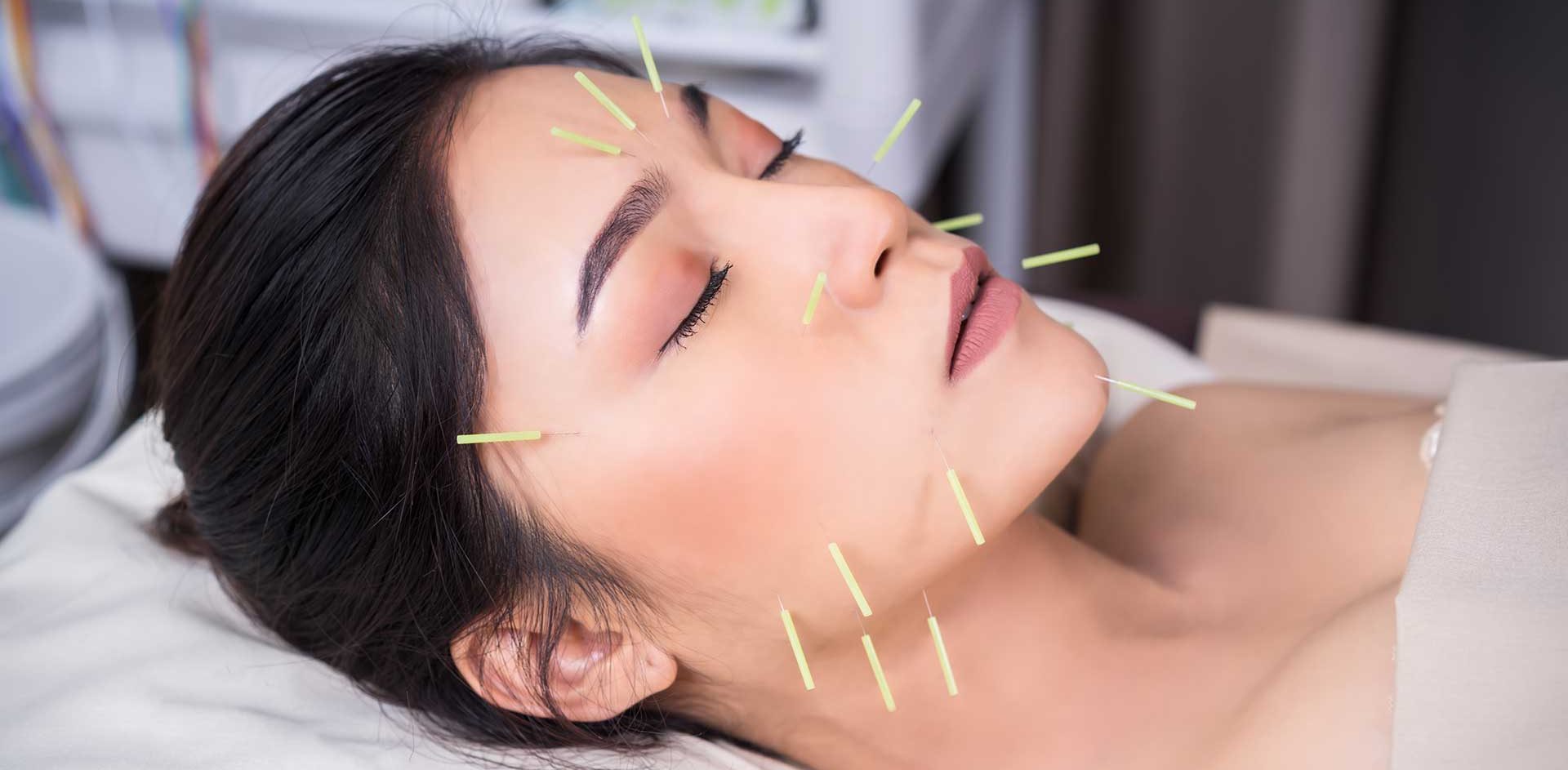 acupuncture et nevralgie faciale par le dr Nguyen à Paris