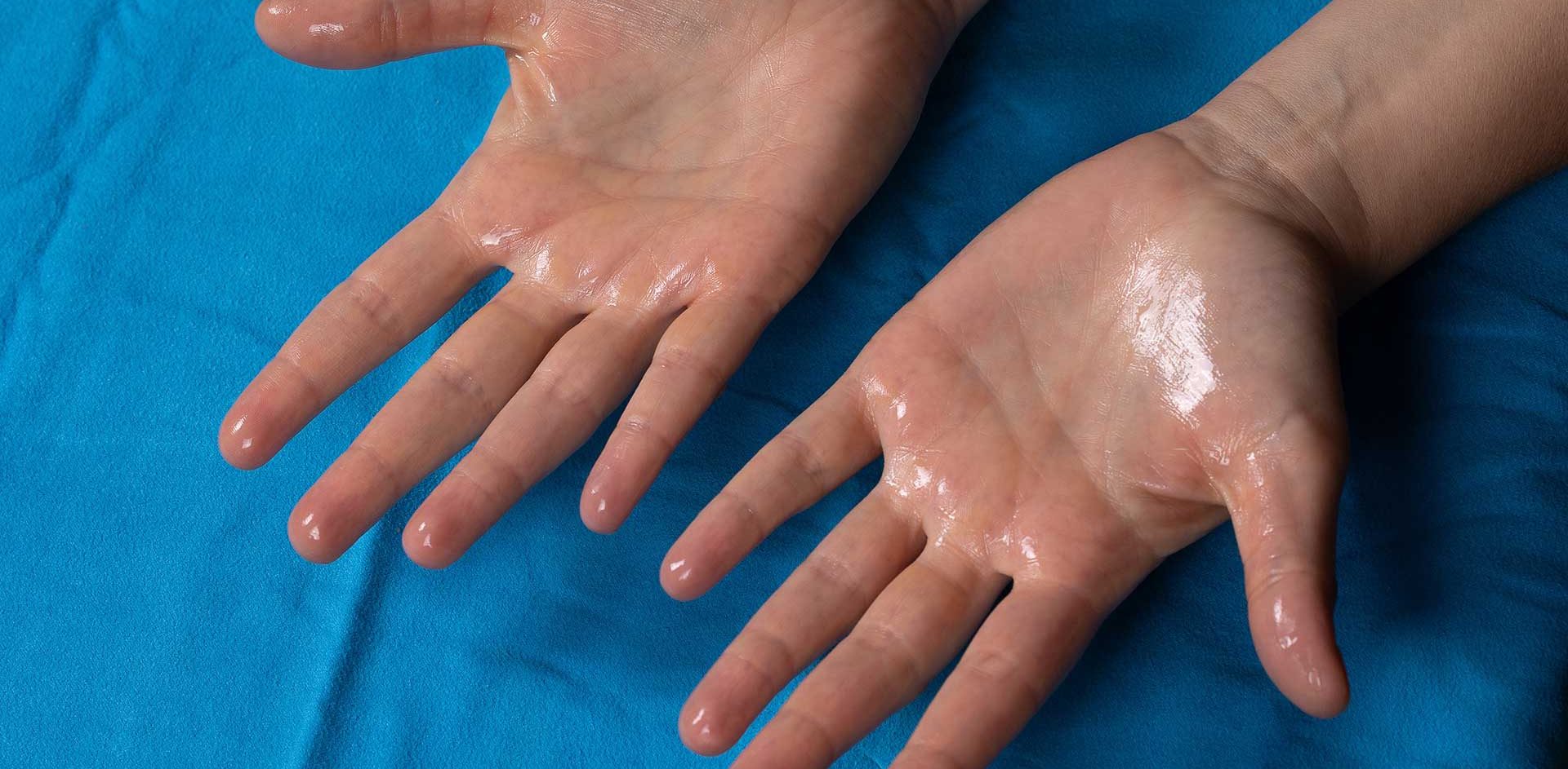 Acupuncture et transpiration des mains par le dr Nguyen à Paris