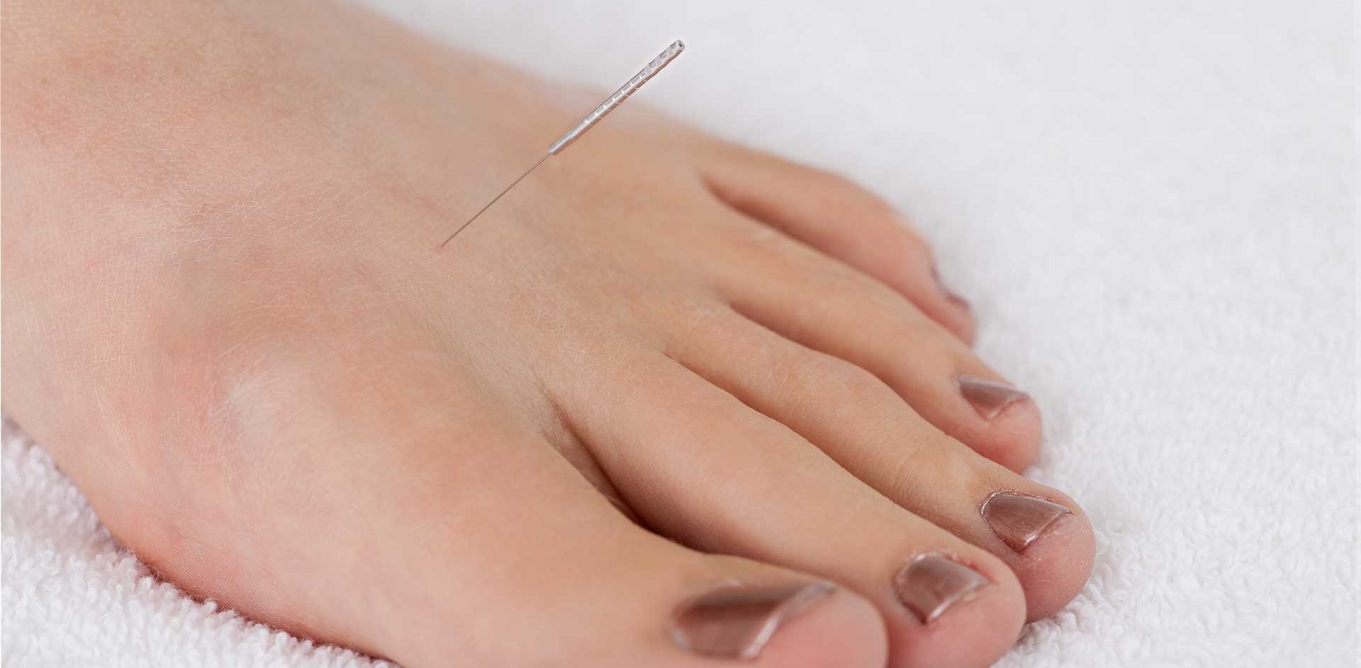 Algodystrophie : unifier corps et esprit grâce à l’acupuncture